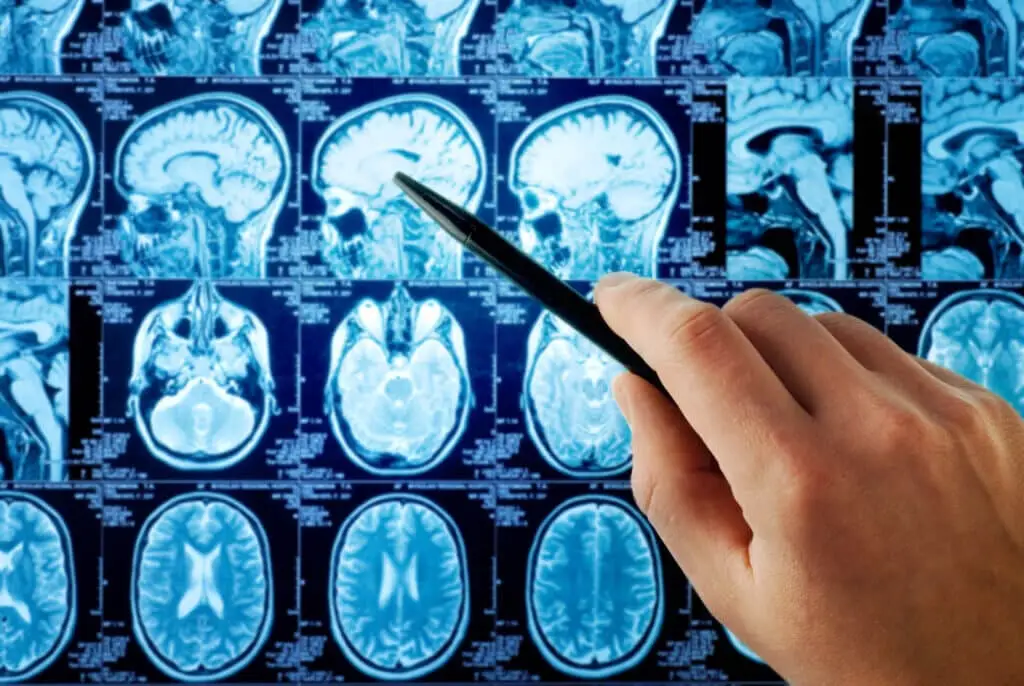 Hand pointing to brain MRI images during a neuropsychological exam.